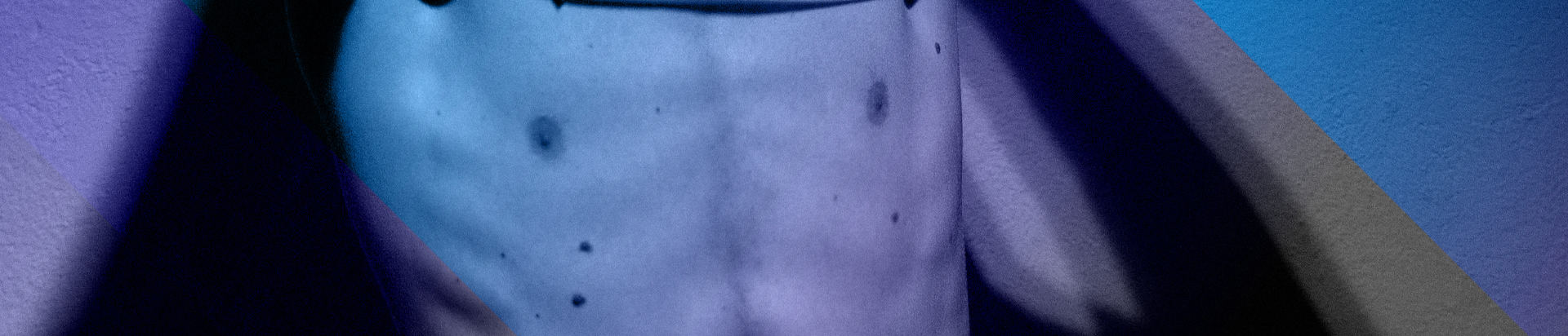 breast reduction gynaecomastia